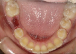 Invisalign Treatment