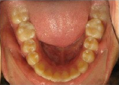 Invisalign Treatment