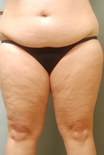 SmartLipo Complete Wrap around 