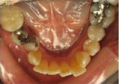 Invisalign Treatment