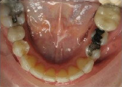Invisalign Treatment
