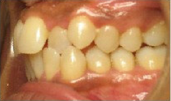 Invisalign Treatment