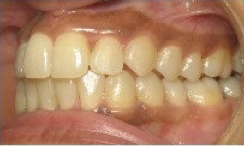 Invisalign Treatment