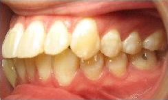 Invisalign Treatment