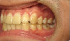 Invisalign Treatment
