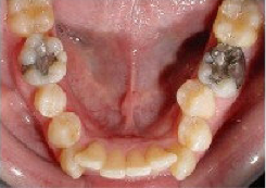 Invisalign Treatment