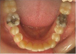 Invisalign Treatment