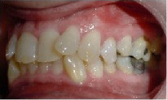 Invisalign Treatment