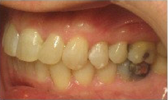 Invisalign Treatment