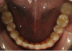 Invisalign Treatment