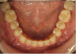 Invisalign Treatment