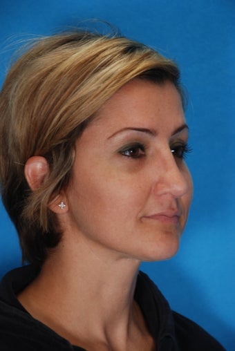 Rhinoplasty (nose job, nasal surgery)