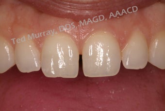 Cosmetic Bonding to close space