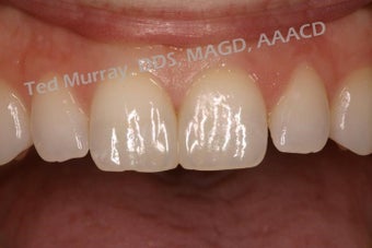 Cosmetic Bonding to close space
