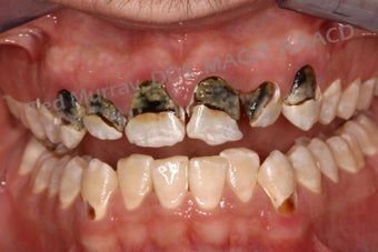Direct Composite Resin Veneers