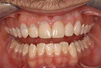 Direct Composite Resin Veneers