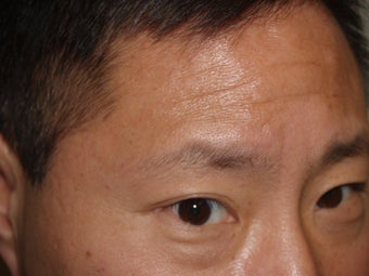 Lower Lid Blepharoplasty