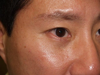 Lower Lid Blepharoplasty