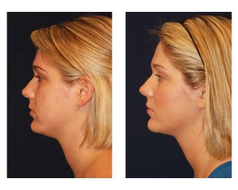 Fat Grafting / Chin Lipo