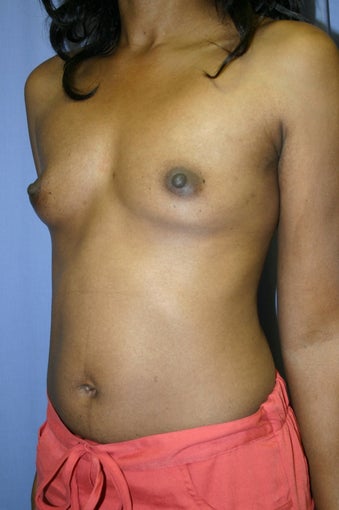 Breast Augmentation 
