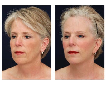 Neck Lift, Fat Grafting