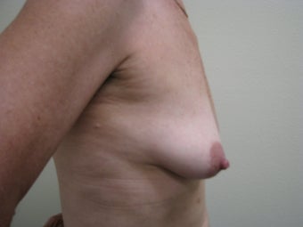 Breast Reconstruction Immediate 