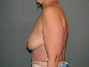breast lift with augmentation