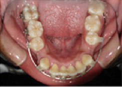 Braces and Extraction