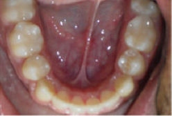 Braces and Extraction