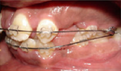 Braces and Extraction