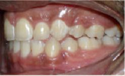 Braces and Extraction