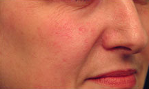 Laser Vein Treatment