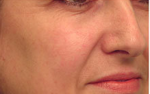 Laser Vein Treatment