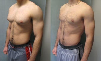 Gynecomastia