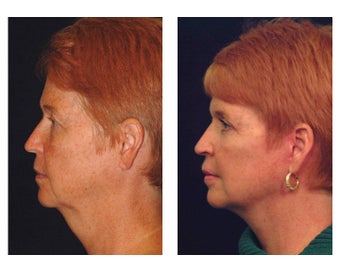 Lower Face & Neck Lift