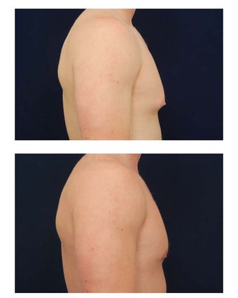 Gynecomastia