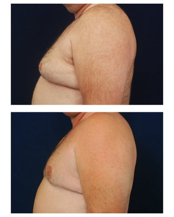 Gynecomastia
