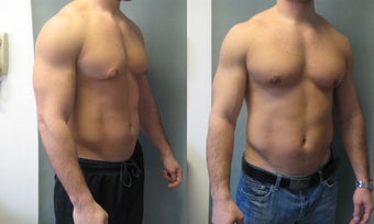 Gynecomastia New youk