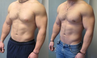 Gynecomastia surgery