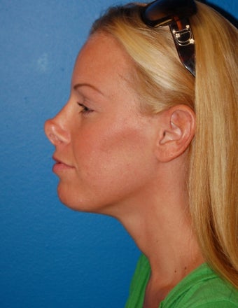 Revision Rhinoplasty