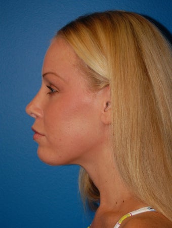 Revision Rhinoplasty
