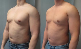 Gynecomastia 