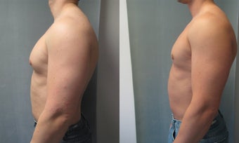 Gynecomastia 