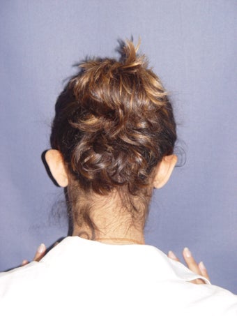 Otoplasty
