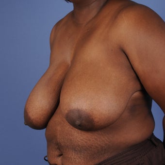 Breast Reduction