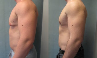 Gynecomastia 