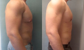 Gynecomastia 
