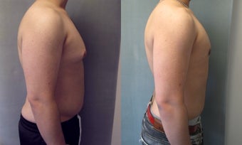 Gynecomastia 