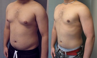 Gynecomastia 