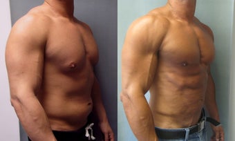 Gynecomastia 